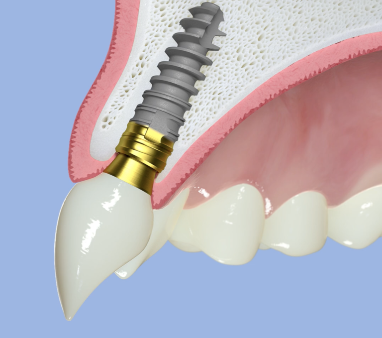 顎の骨に埋入されたインプラント（人工歯根）の構造図。仙台市宮城野区で噛む機能を回復するおすすめの治療。