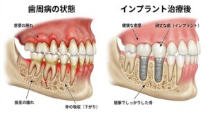 歯周病による骨の吸収(下がり)と、インプラント治療後の比較図。仙台市宮城野区の歯科医院が解説する、インプラントによる顎の骨と歯茎の健康維持。