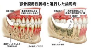 歯周病による骨吸収と、歯を失った後の顎骨廃用性萎縮の比較図。仙台市宮城野区の歯科医院が解説するインプラント治療で骨を守る重要性のイメージ。