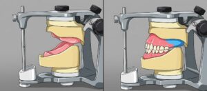 咬合器を用いた、歯を失った後の顎堤吸収（廃用性萎縮）と総入れ歯による補綴の比較図。仙台市宮城野区の歯科医院によるインプラント・入れ歯解説用。