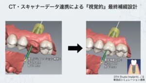 しらとり歯科医院（仙台市宮城野区）の学会認定専門医によるインプラント精密シミュレーション（ケンくんのケース）。口腔内スキャナーとCTデータを連携させ、骨が少ない奥歯への径5.0mm・長さ13mmのインプラント埋入計画と、最終的に装着されるリアルな被せ物のイメージをビジュアル化して比較。膿除去と骨造成を伴う複雑な症例における安全性確保への取り組みを示す。