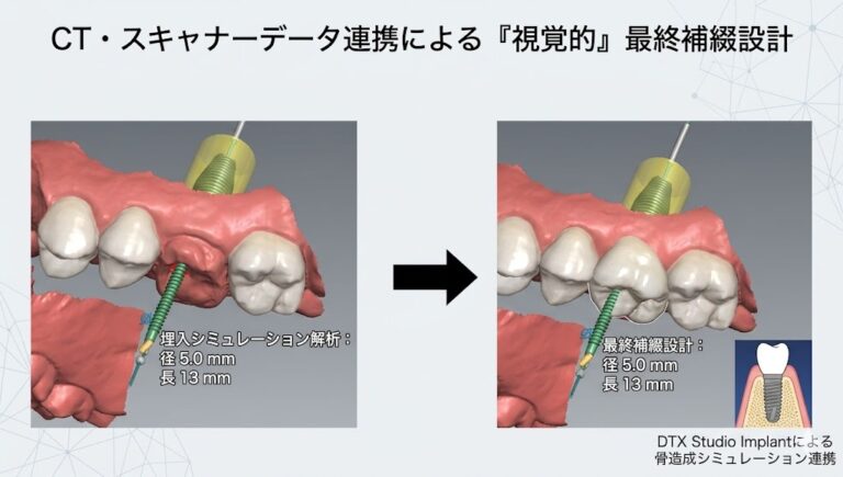 しらとり歯科医院(仙台市宮城野区)の学会認定専門医によるインプラント精密シミュレーション(ケンくんのケース)。口腔内スキャナーとCTデータを連携させ、骨が少ない奥歯への径5.0mm・長さ13mmのインプラント埋入計画と、最終的に装着されるリアルな被せ物のイメージをビジュアル化して比較。膿除去と骨造成を伴う複雑な症例における安全性確保への取り組みを示す。
