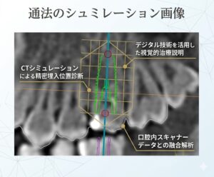 しらとり歯科医院（仙台市宮城野区）の、CTシミュレーション技術と口腔内スキャナーデータを融合したインプラント精密治療の視覚的解説図。通法のシュミレーション画像を基に、DTX Studioを活用した診断・説明の取り組みを示す。専門医が解説。