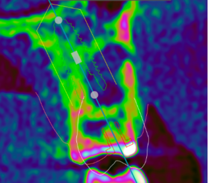 仙台市宮城野区のインプラント治療でおすすめの歯科医院が導入する、シミュレーションソフトを用いた補綴主導型精密インプラント埋入計画のCT診断画像