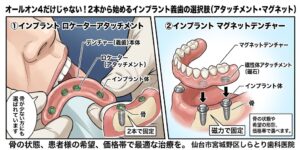 仙台市宮城野区のしらとり歯科医院による、インプラントオーバーデンチャーの解説図。左側は「インプラント ロケーターアタッチメント」の実臨床写真、右側は「インプラント マグネットデンチャー(磁性体アタッチメント)」の3D模型画像。2本のインプラントを利用して義歯を固定する治療の選択肢を示している。 タイトル 仙台市宮城野区で選ぶインプラント義歯:ロケーター対マグネット比較