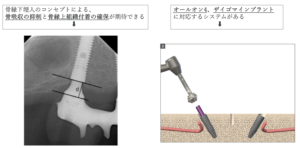 仙台市宮城野区でインプラントの名医・おすすめ歯科医院を目指す当院が解説。ネオデントインプラントの特徴（骨縁下埋入による骨吸収抑制、オールオン4・ザイゴマ対応システム）を示すエックス線写真と術式イメージ図。専門医が執刀。