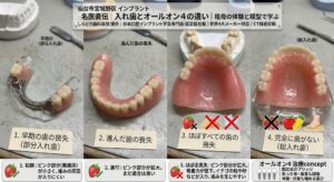 仙台市宮城野区しらとり歯科医院。祖母の体験談で語る、入れ歯とオールオン4インプラントの違い。歯の喪失の進行度と義歯床の大きさの変化を模型で示す4段階図解。1:部分入れ歯、2:進行、3:ほぼ全喪失、4:総入れ歯。CT診断、世界4大メーカー対応の専門医による精密診療をご案内。