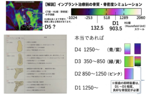 仙台市宮城野区でインプラント治療を行う歯科医院の解説図。インプラント手術当日に仮歯を固定できる基準として、CT値やHU値(ハンスフィールド値)を用いたサーモグラフィーでの骨密度シミュレーションと、D1からD4(D5)の骨質分類の特徴を説明している画像。