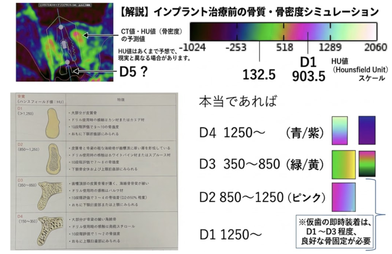仙台市宮城野区でインプラント治療を行う歯科医院の解説図。インプラント手術当日に仮歯を固定できる基準として、CT値やHU値(ハンスフィールド値)を用いたサーモグラフィーでの骨密度シミュレーションと、D1からD4(D5)の骨質分類の特徴を説明している画像。
