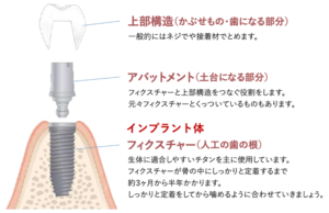 仙台市宮城野区の歯科医院が解説するインプラントの基本構造(上部構造・アバットメント・インプラント体)イラスト