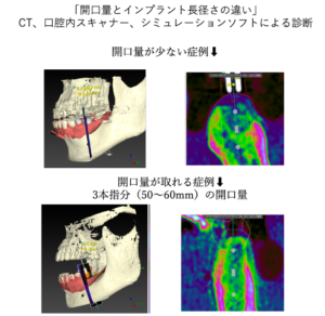 CT・シミュレーションソフトによる開口量とインプラント埋入計画の比較診断画像｜仙台市宮城野区しらとり歯科医院