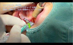 口腔内でインプラント体（フィクスチャー）を埋入する一次手術の様子｜仙台市宮城野区しらとり歯科医院