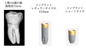 上顎6歳臼歯（歯根長13mm）とレギュラーサイズ13.0mm・ショートサイズのインプラント比較図｜仙台市宮城野区しらとり歯科医院