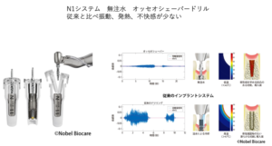 ノーベルバイオケアN1システムの無注水オッセオシェーパーと従来ドリルの比較図｜仙台市宮城野区しらとり歯科医院