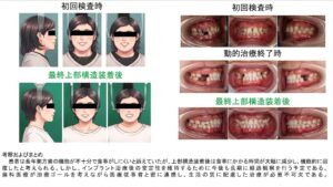 先天性無歯症への矯正・インプラント複合治療の症例スライド。仙台市宮城野区のしらとり歯科医院（日本口腔インプラント学会、国際口腔インプラント学会専門医）による。初回検査時、動的治療終了時、最終上部構造装着後の顔貌（プライバシー保護のためアニメ風イラスト加工）と口腔内写真。考察付き。