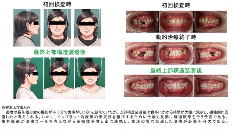 先天性無歯症への矯正・インプラント複合治療の症例スライド。仙台市宮城野区のしらとり歯科医院(日本口腔インプラント学会、国際口腔インプラント学会専門医)による。初回検査時、動的治療終了時、最終上部構造装着後の顔貌(プライバシー保護のためアニメ風イラスト加工)と口腔内写真。考察付き。