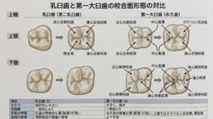 乳臼歯（第二乳臼歯）と永久歯（第一大臼歯）の咬合面形態・咬頭数・溝の違いを対比した解説図