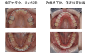 10本欠損の先天性無歯症における矯正治療中の歯の移動過程とインプラント治療終了後の保定装置装着時の上顎・下顎口腔内写真