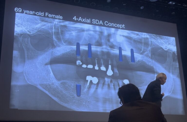 仙台市宮城野区しらとり歯科医院が学んだ短縮歯列(SDA)コンセプトに基づくインプラント治療のレントゲン症例スライド(69歳女性)